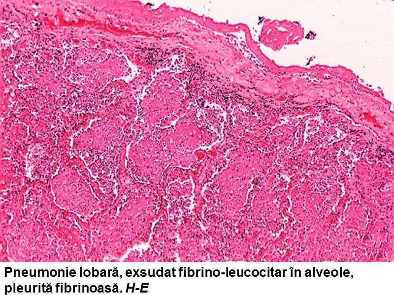 Pneumonie lobară, exsudat fibrino-leucocitar în alveole, pleurită fibrinoasă. H-E
